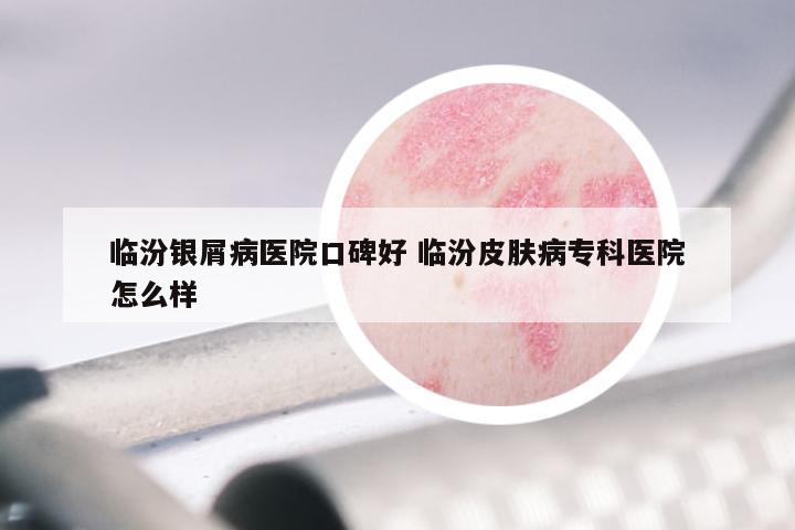 临汾银屑病医院口碑好 临汾皮肤病专科医院怎么样