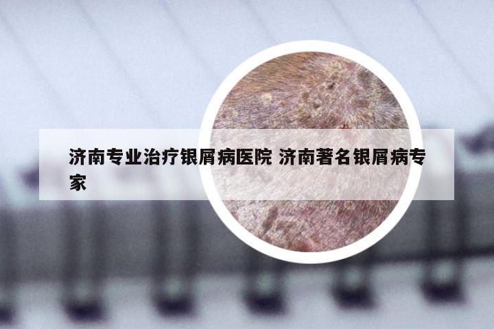 济南专业治疗银屑病医院 济南著名银屑病专家