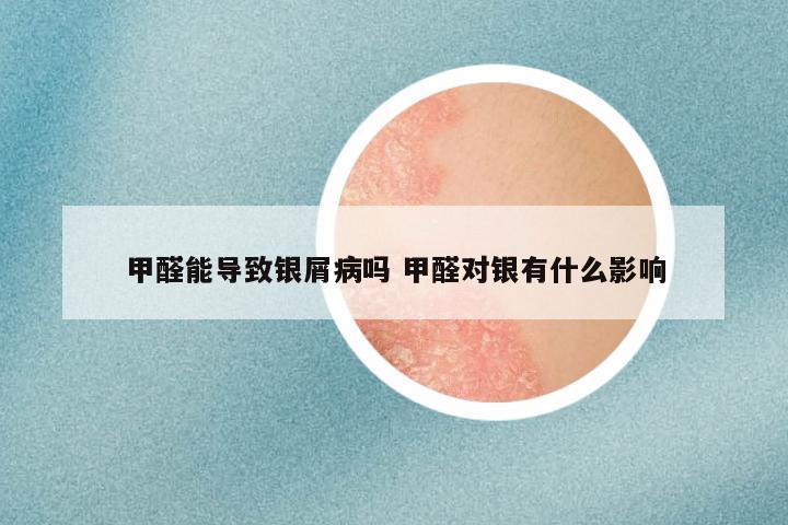 甲醛能导致银屑病吗 甲醛对银有什么影响