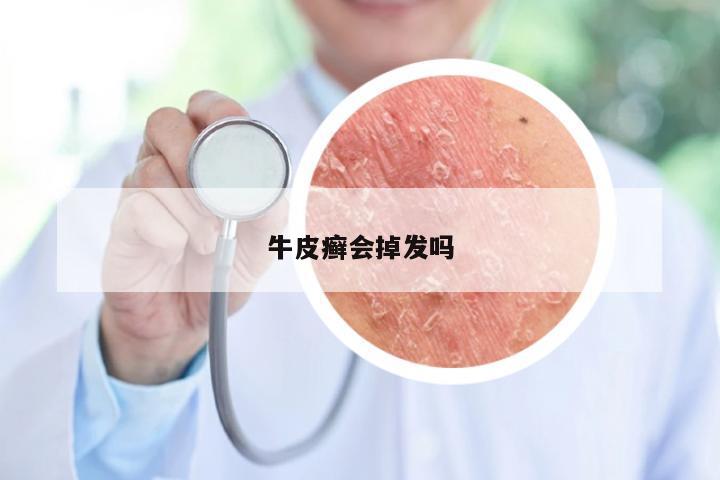 牛皮癣会掉发吗