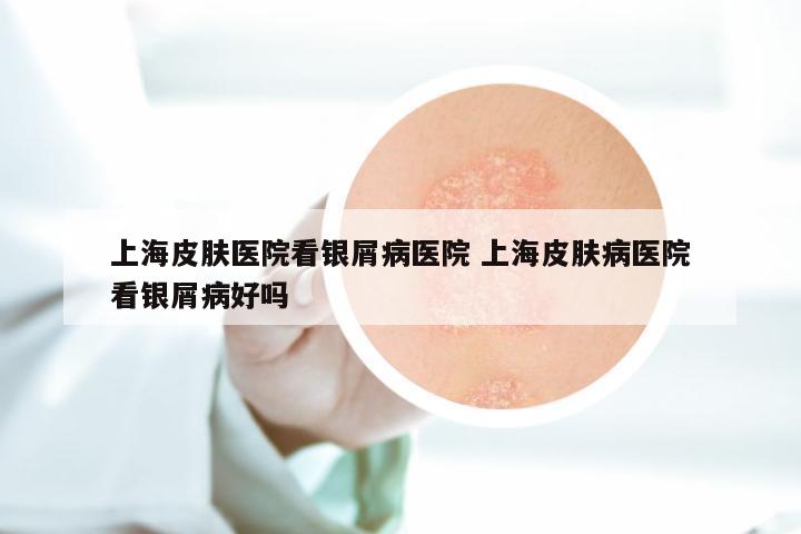 上海皮肤医院看银屑病医院 上海皮肤病医院看银屑病好吗