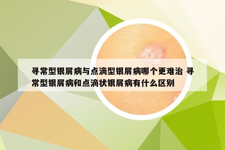 寻常型银屑病与点滴型银屑病哪个更难治 寻常型银屑病和点滴状银屑病有什么区别