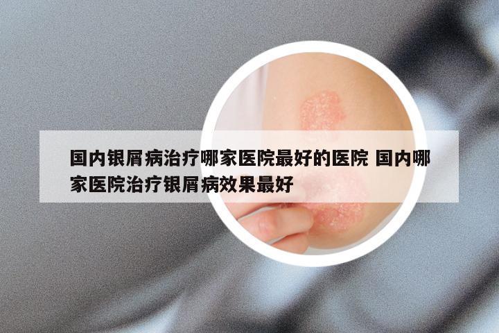 国内银屑病治疗哪家医院最好的医院 国内哪家医院治疗银屑病效果最好