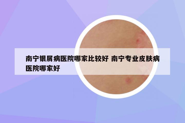 南宁银屑病医院哪家比较好 南宁专业皮肤病医院哪家好