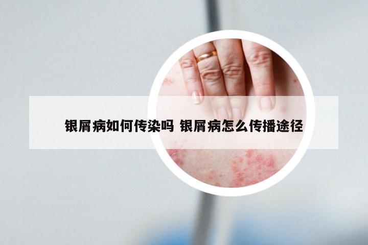 银屑病如何传染吗 银屑病怎么传播途径