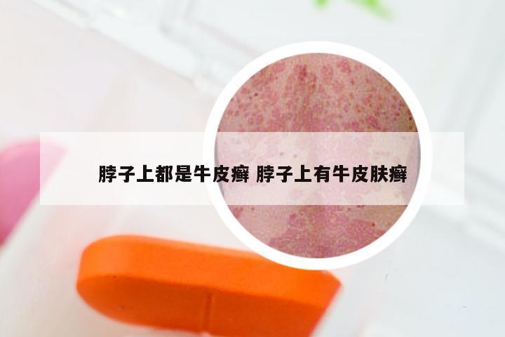 脖子上都是牛皮癣 脖子上有牛皮肤癣