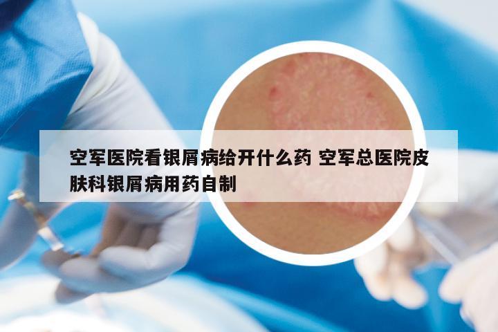 空军医院看银屑病给开什么药 空军总医院皮肤科银屑病用药自制