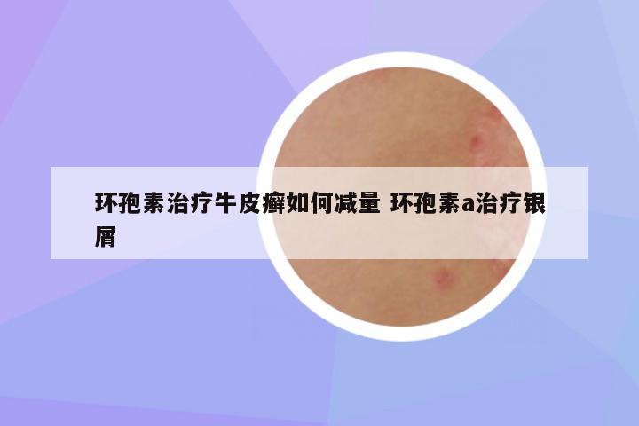 环孢素治疗牛皮癣如何减量 环孢素a治疗银屑