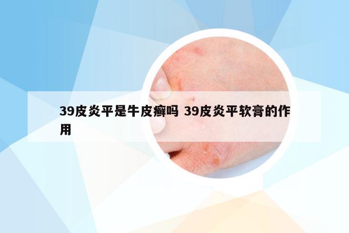 39皮炎平是牛皮癣吗 39皮炎平软膏的作用