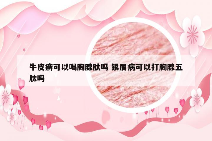 牛皮癣可以喝胸腺肽吗 银屑病可以打胸腺五肽吗