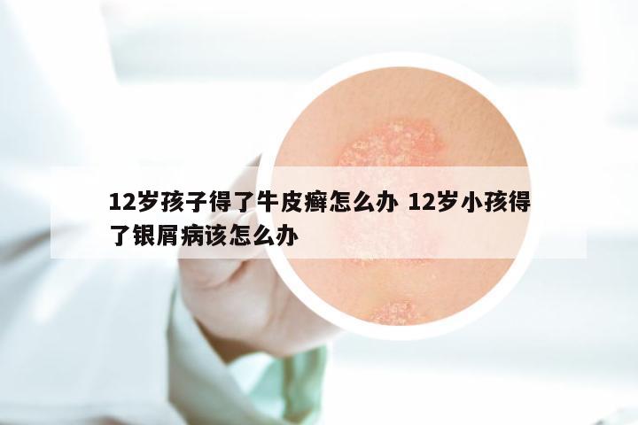 12岁孩子得了牛皮癣怎么办 12岁小孩得了银屑病该怎么办