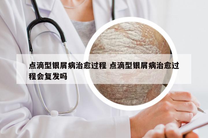 点滴型银屑病治愈过程 点滴型银屑病治愈过程会复发吗