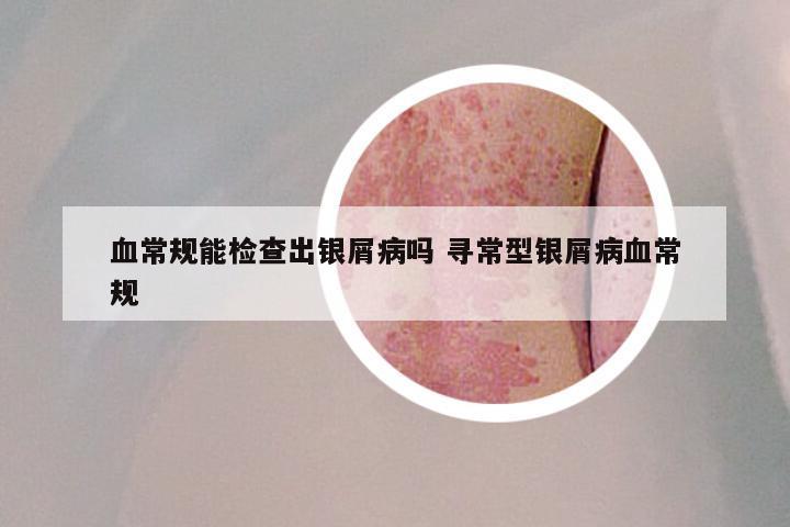 血常规能检查出银屑病吗 寻常型银屑病血常规