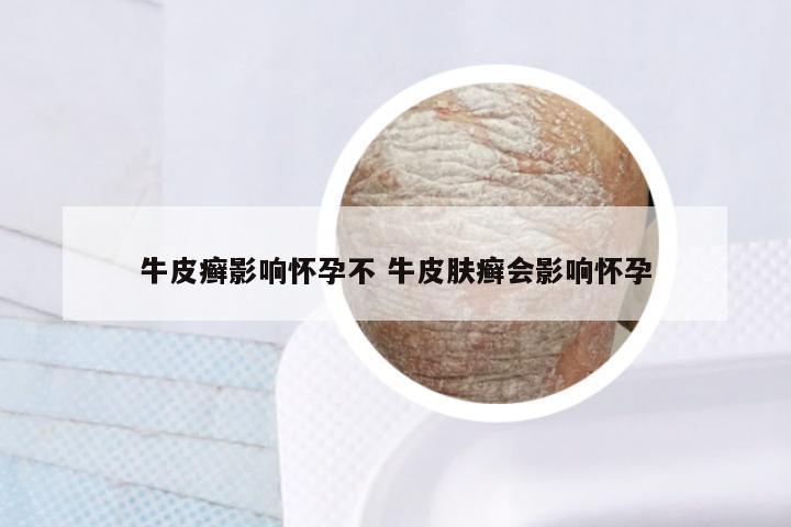 牛皮癣影响怀孕不 牛皮肤癣会影响怀孕