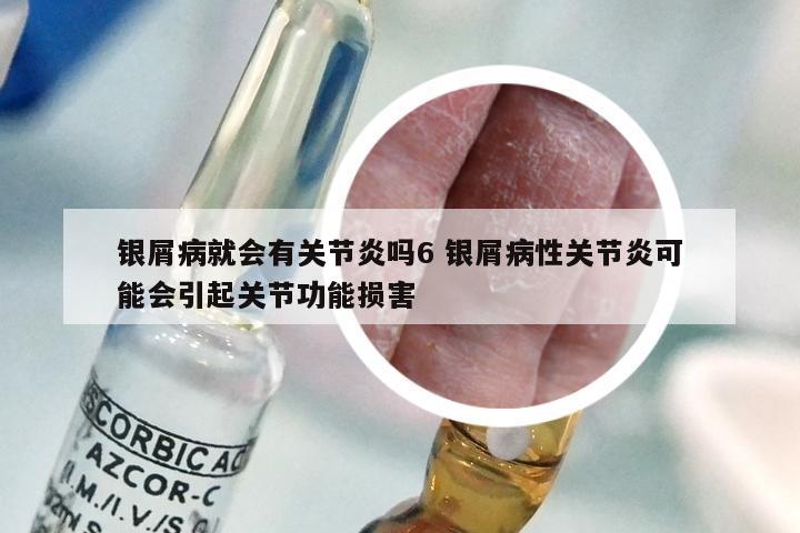 银屑病就会有关节炎吗6 银屑病性关节炎可能会引起关节功能损害