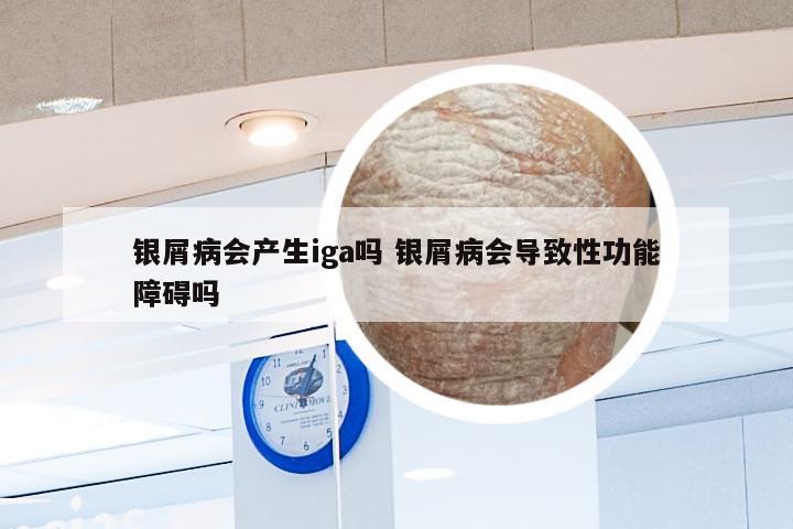 银屑病会产生iga吗 银屑病会导致性功能障碍吗