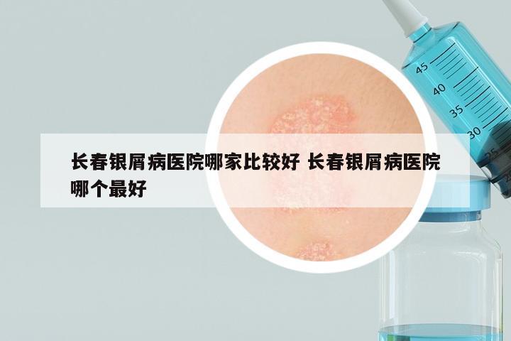 长春银屑病医院哪家比较好 长春银屑病医院哪个最好