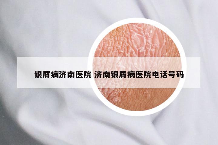 银屑病济南医院 济南银屑病医院电话号码