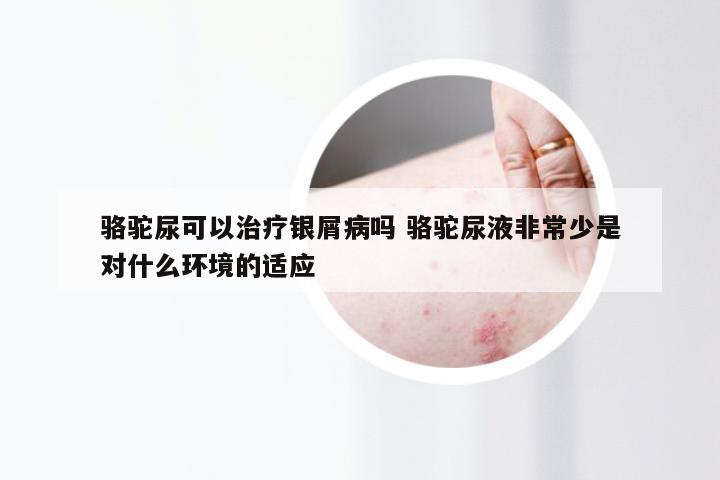 骆驼尿可以治疗银屑病吗 骆驼尿液非常少是对什么环境的适应