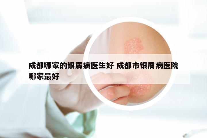 成都哪家的银屑病医生好 成都市银屑病医院哪家最好