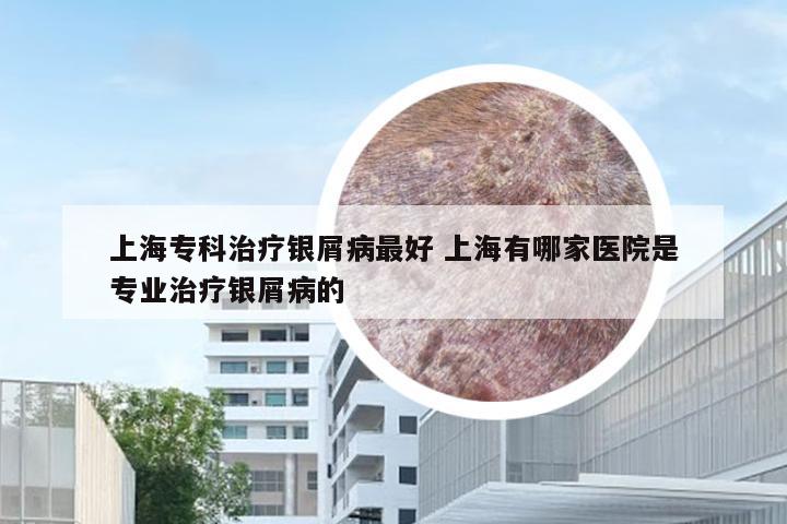上海专科治疗银屑病最好 上海有哪家医院是专业治疗银屑病的
