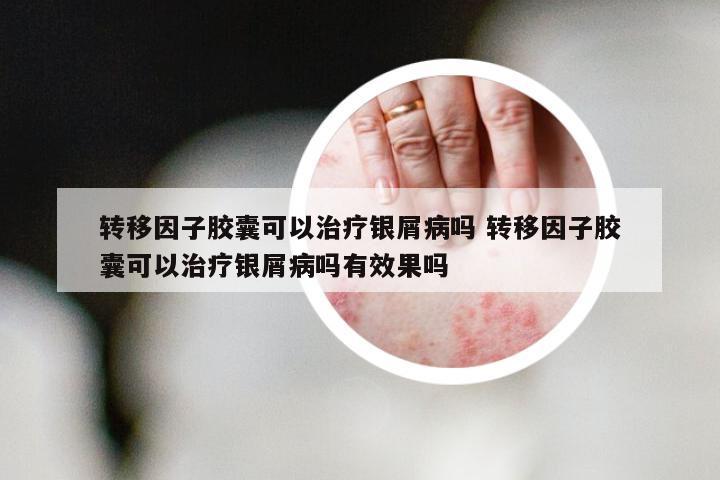 转移因子胶囊可以治疗银屑病吗 转移因子胶囊可以治疗银屑病吗有效果吗