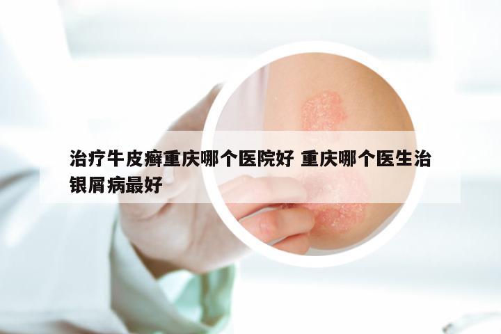 治疗牛皮癣重庆哪个医院好 重庆哪个医生治银屑病最好