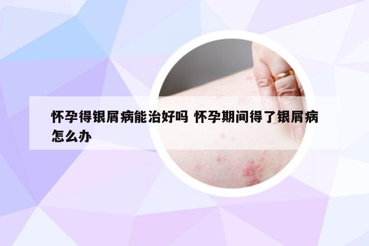 怀孕得银屑病能治好吗 怀孕期间得了银屑病怎么办