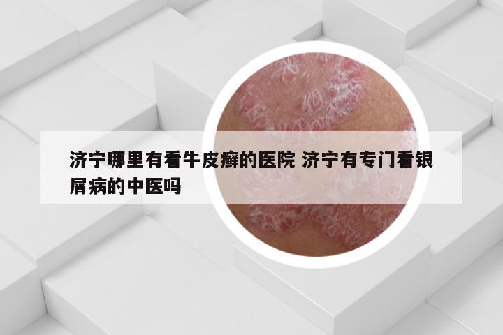 济宁哪里有看牛皮癣的医院 济宁有专门看银屑病的中医吗