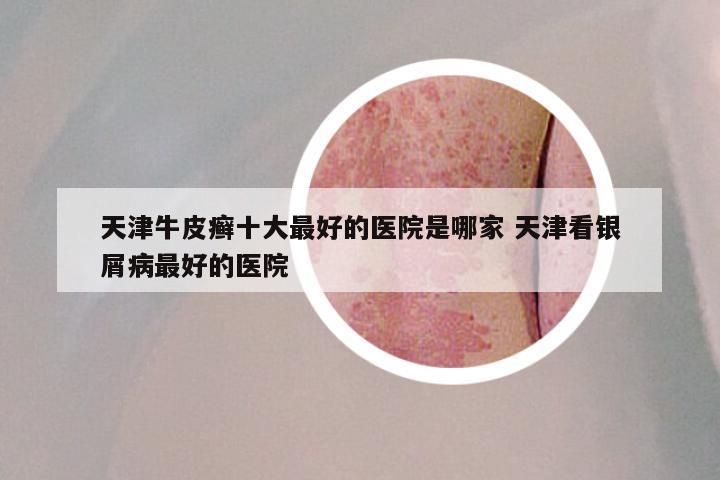 天津牛皮癣十大最好的医院是哪家 天津看银屑病最好的医院
