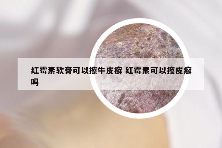 红霉素软膏可以擦牛皮癣 红霉素可以擦皮癣吗
