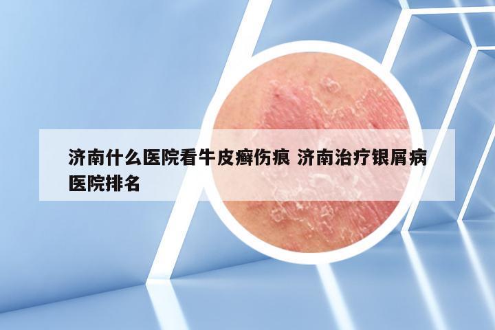 济南什么医院看牛皮癣伤痕 济南治疗银屑病医院排名