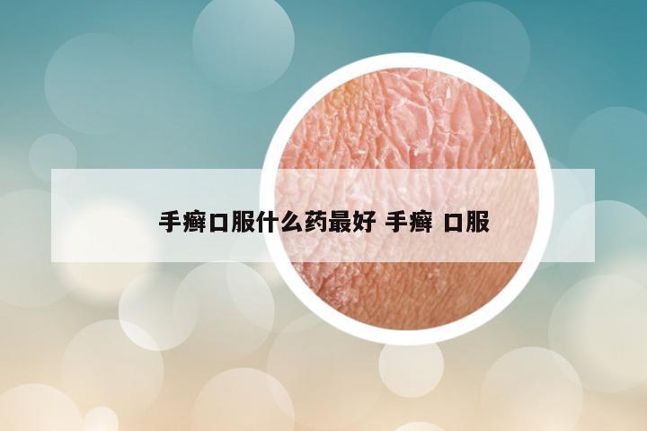 手癣口服什么药最好 手癣 口服