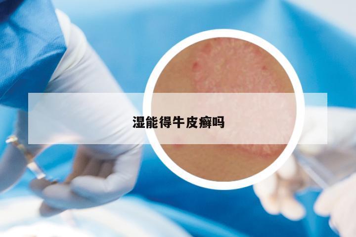 湿能得牛皮癣吗