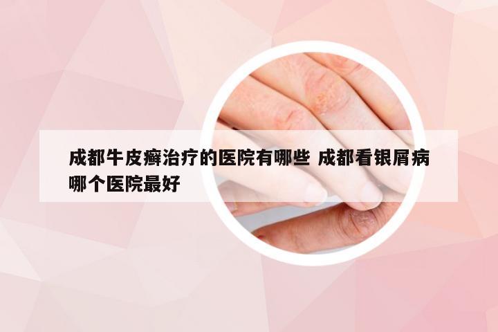 成都牛皮癣治疗的医院有哪些 成都看银屑病哪个医院最好