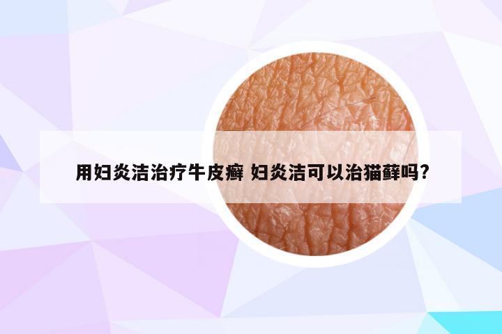 用妇炎洁治疗牛皮癣 妇炎洁可以治猫藓吗?