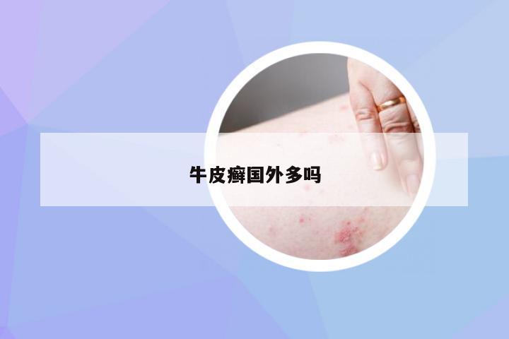 牛皮癣国外多吗