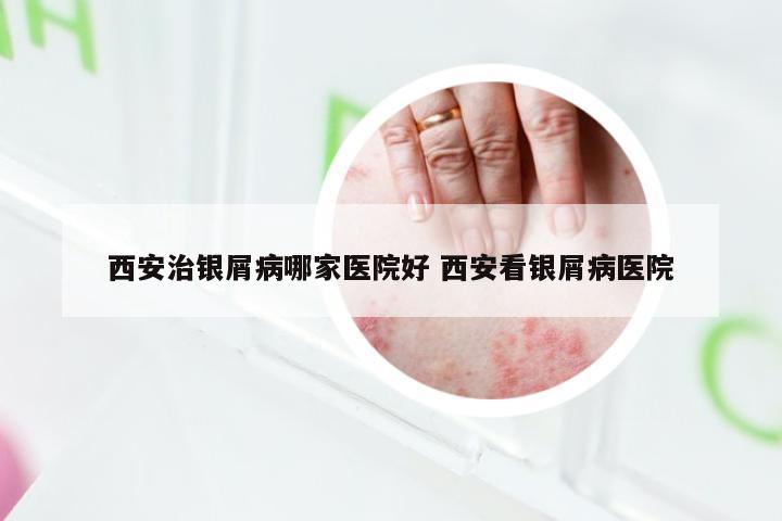 西安治银屑病哪家医院好 西安看银屑病医院