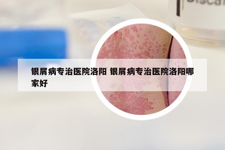 银屑病专治医院洛阳 银屑病专治医院洛阳哪家好