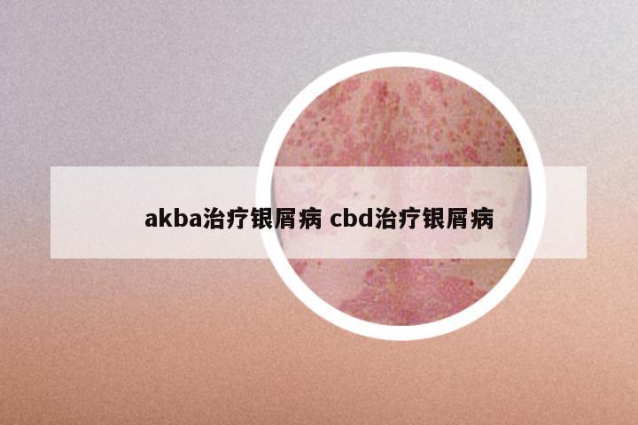akba治疗银屑病 cbd治疗银屑病