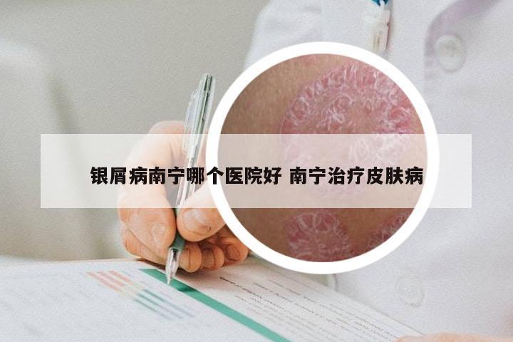 银屑病南宁哪个医院好 南宁治疗皮肤病