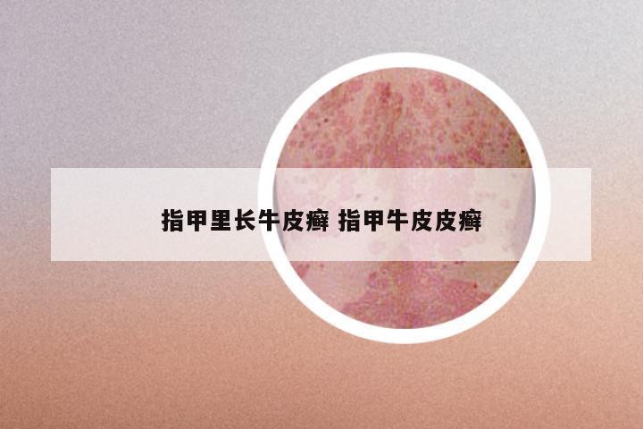 指甲里长牛皮癣 指甲牛皮皮癣