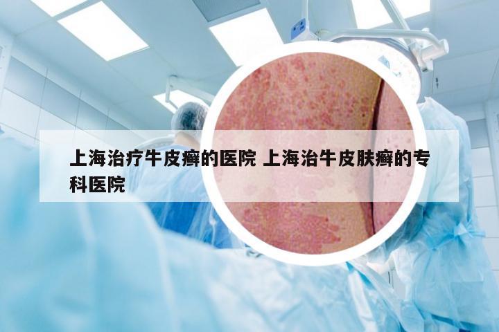 上海治疗牛皮癣的医院 上海治牛皮肤癣的专科医院
