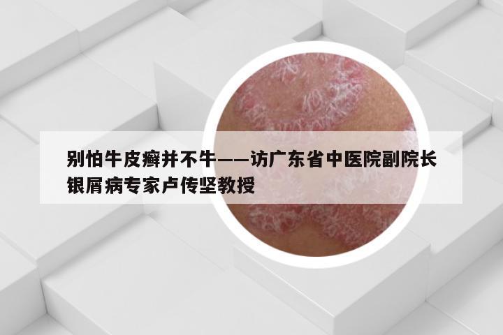 别怕牛皮癣并不牛——访广东省中医院副院长银屑病专家卢传坚教授