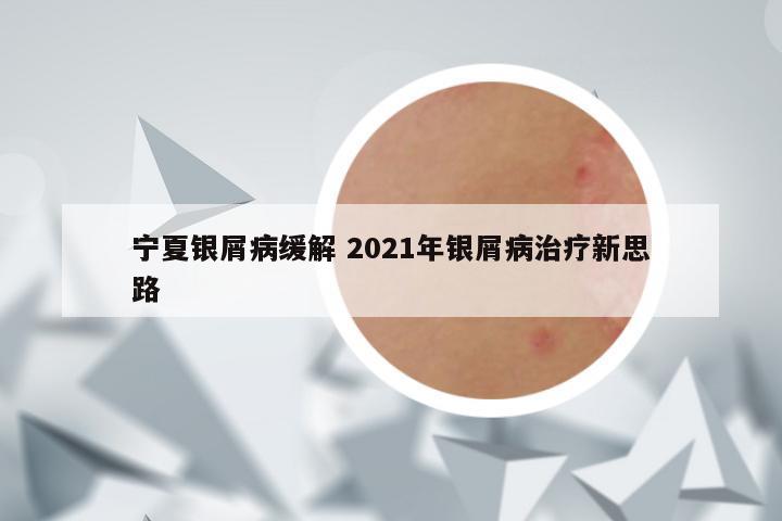 宁夏银屑病缓解 2021年银屑病治疗新思路