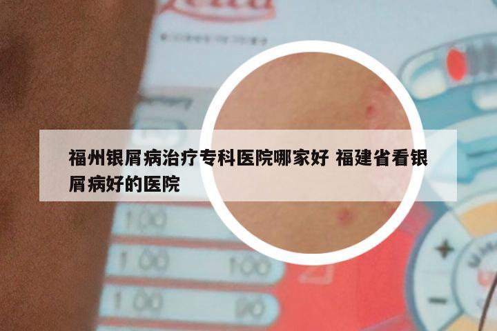 福州银屑病治疗专科医院哪家好 福建省看银屑病好的医院
