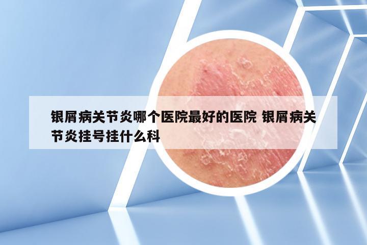 银屑病关节炎哪个医院最好的医院 银屑病关节炎挂号挂什么科