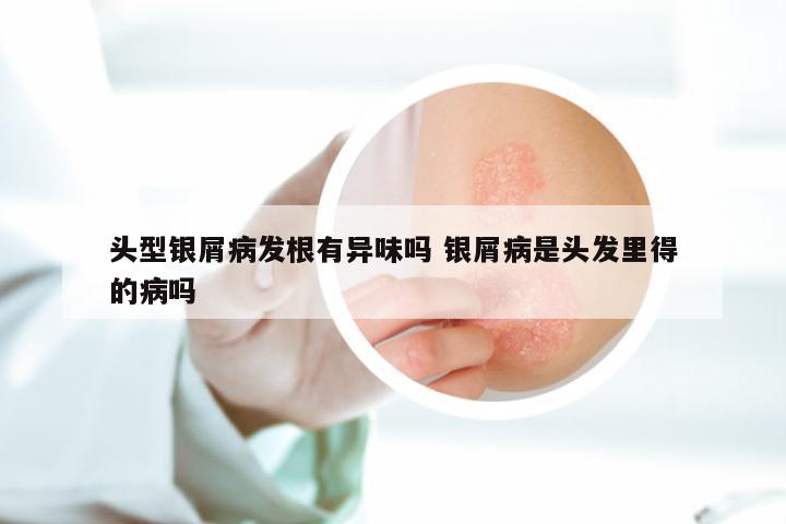 头型银屑病发根有异味吗 银屑病是头发里得的病吗