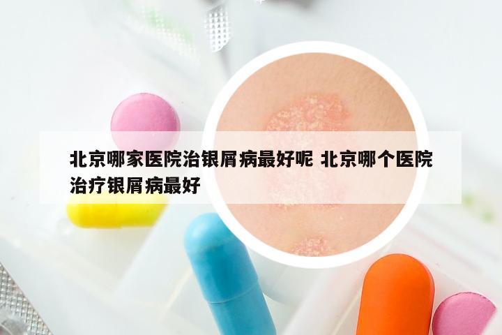 北京哪家医院治银屑病最好呢 北京哪个医院治疗银屑病最好