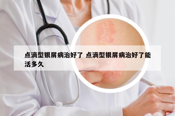 点滴型银屑病治好了 点滴型银屑病治好了能活多久
